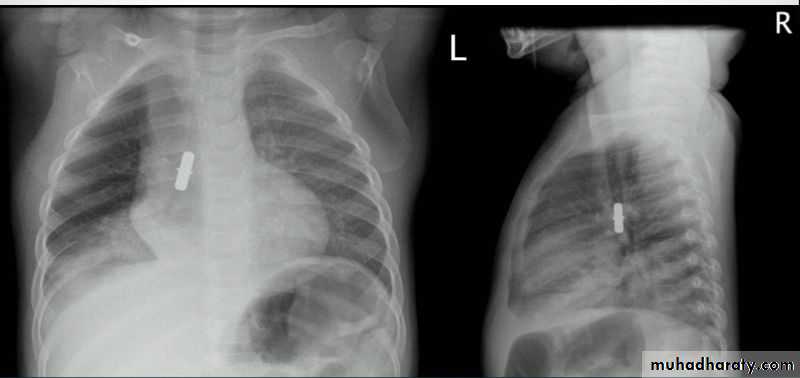Chest surgery