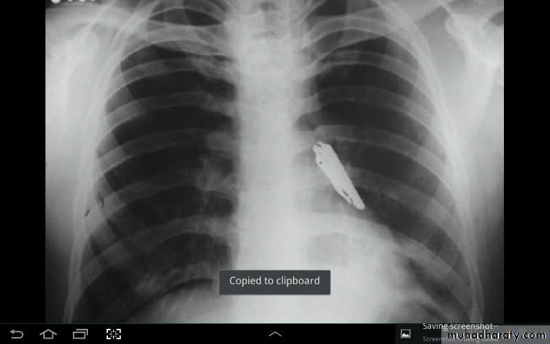 Chest surgery