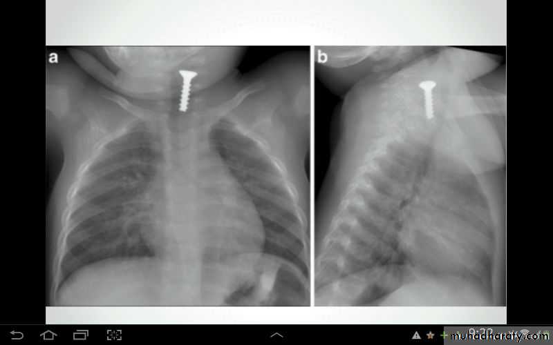 Chest surgery