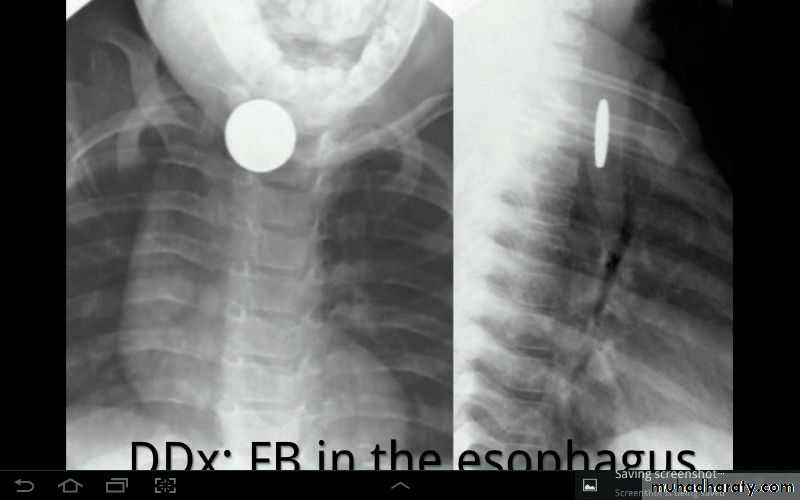 Chest surgery