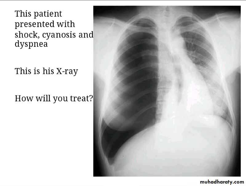 Chest surgery