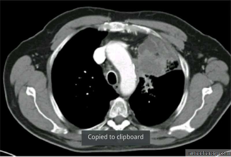 Chest surgery