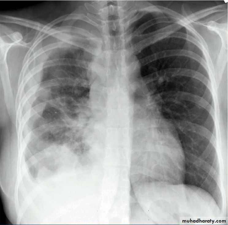Chest surgery