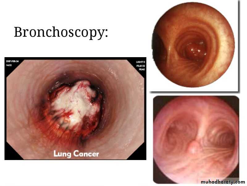 Chest surgery