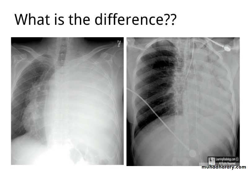 Chest surgery