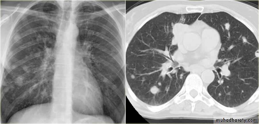 Chest surgery
