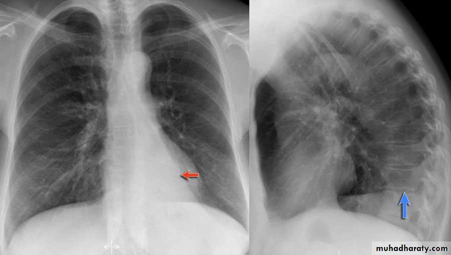 Chest surgery