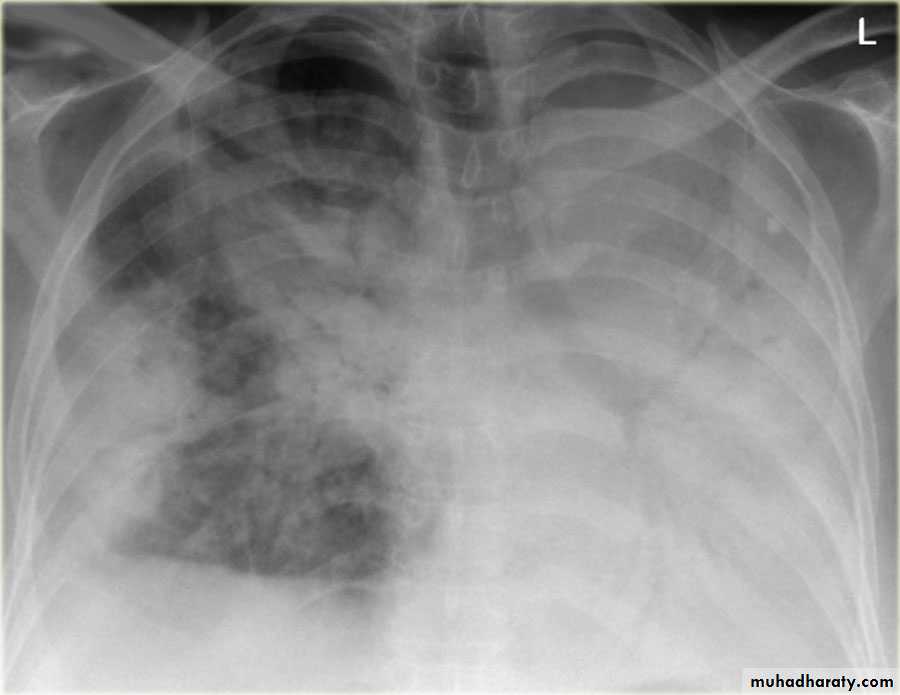 Chest surgery