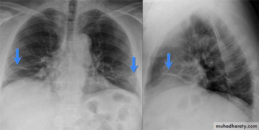 Chest surgery