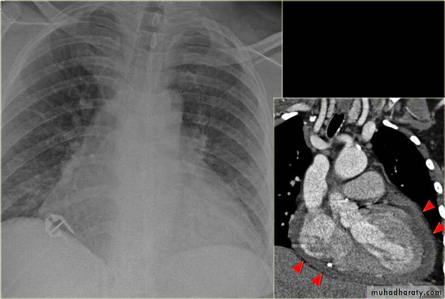 Chest surgery