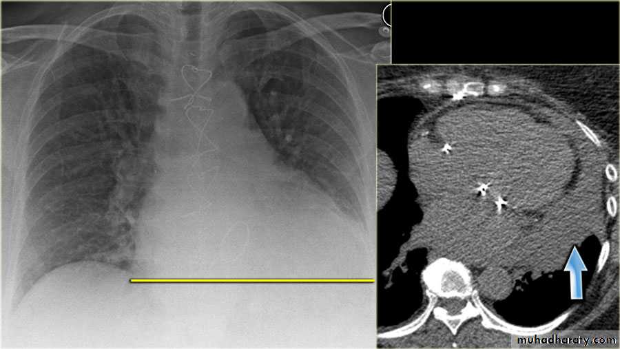 Chest surgery
