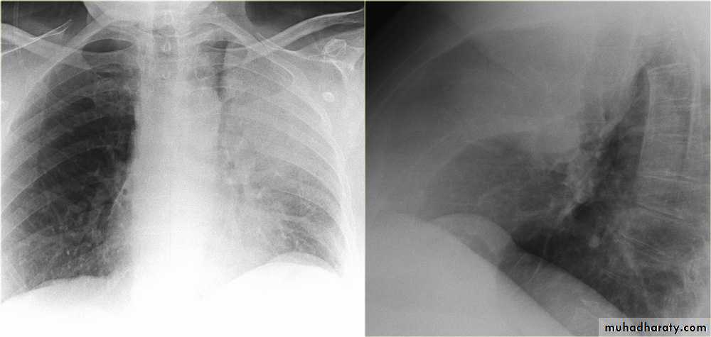 Chest surgery