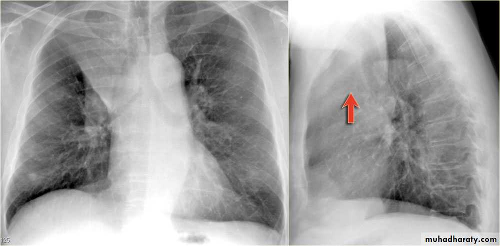 Chest surgery