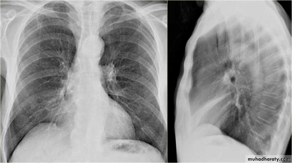 Chest surgery