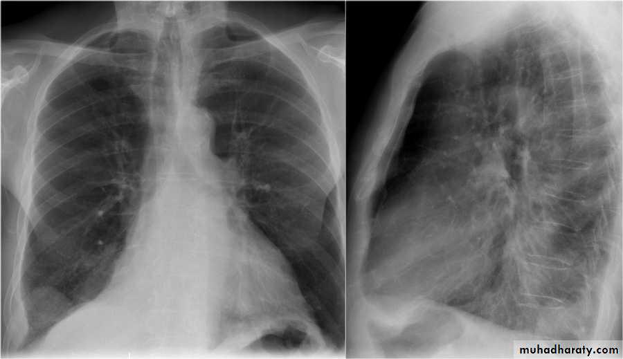 Chest surgery