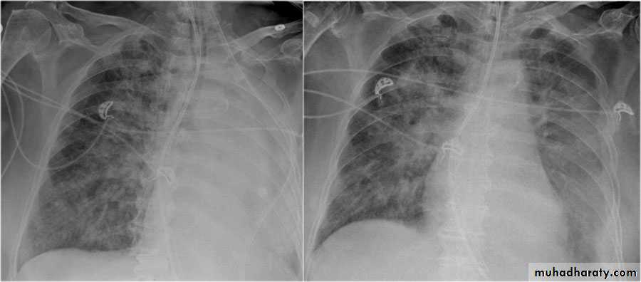 Chest surgery