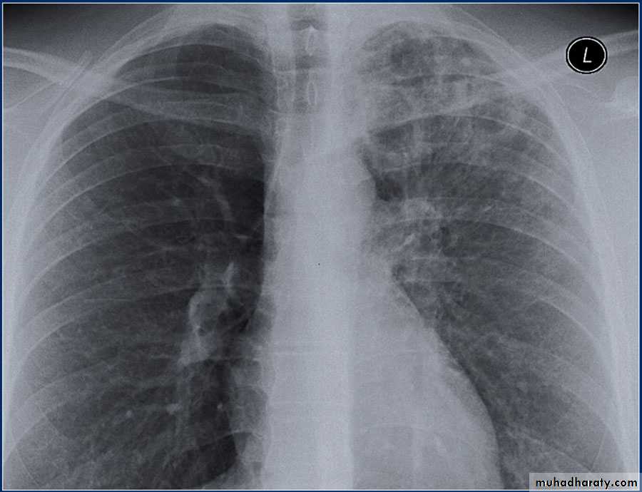 Chest surgery