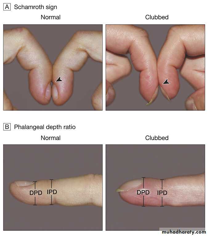 Chest surgery