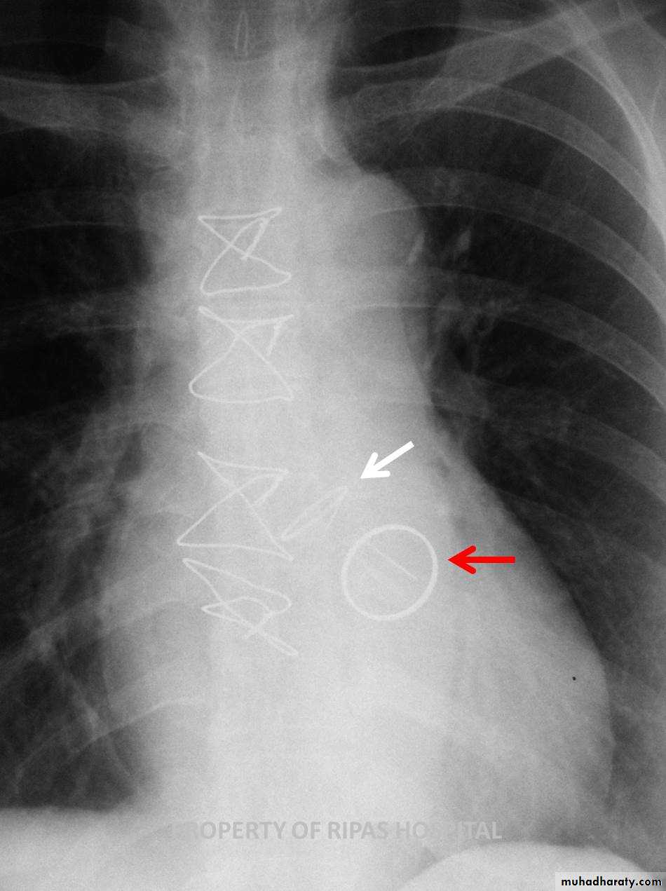 Chest surgery