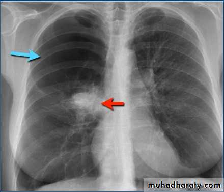 Chest surgery