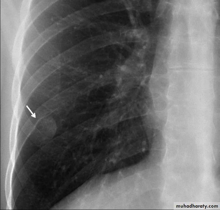 Chest surgery