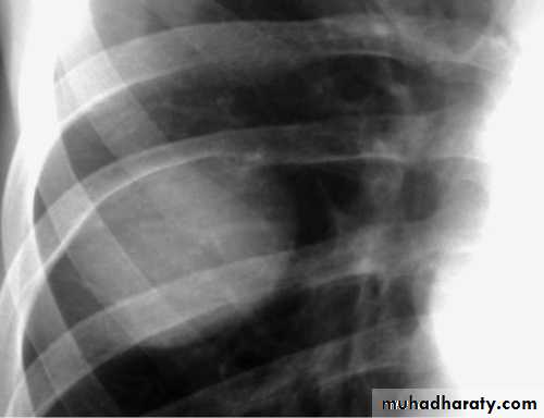 Chest surgery