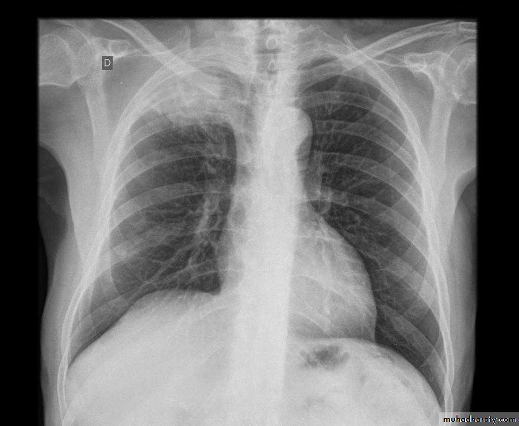 Chest surgery