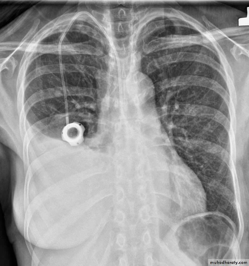 Chest surgery