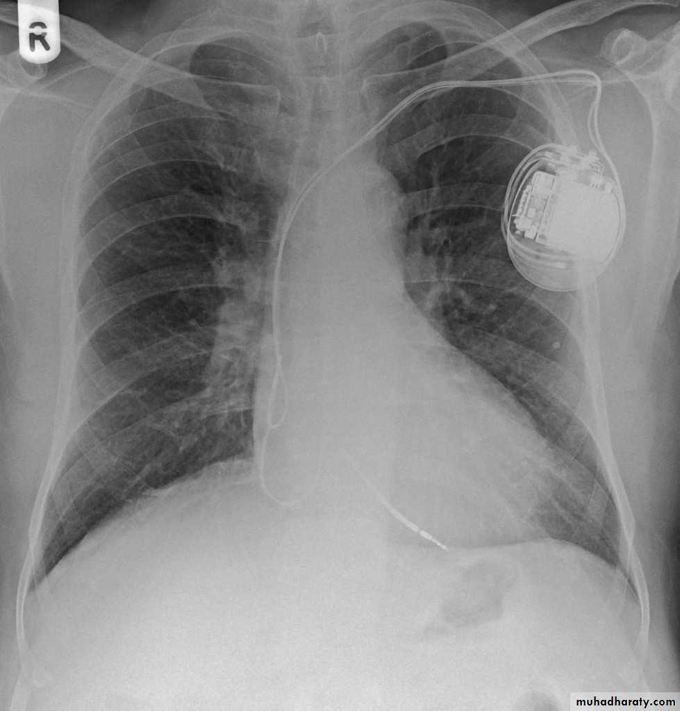 Chest surgery