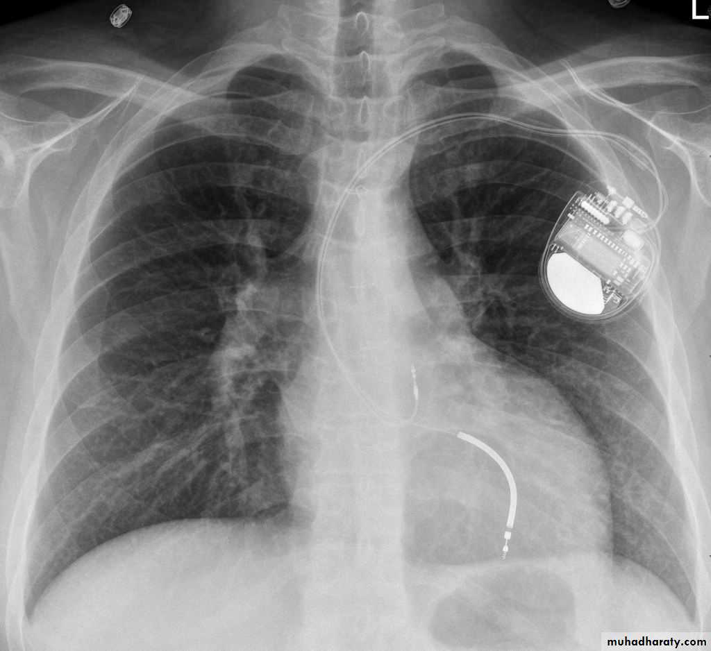 Chest surgery