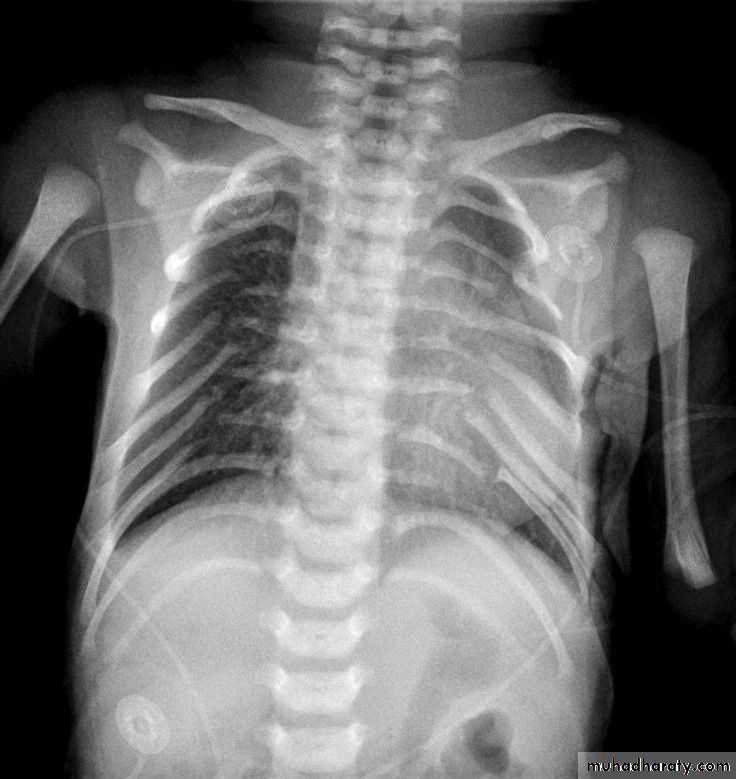 Chest surgery