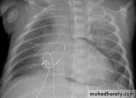 Chest surgery