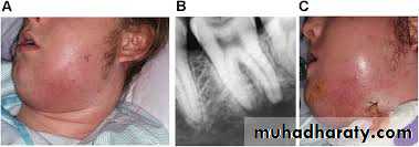 endodontic emergencies