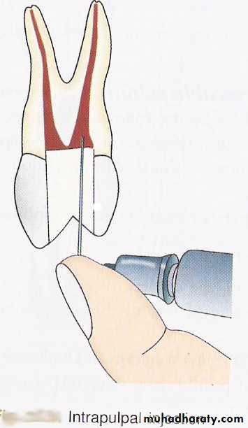 endodontic emergencies