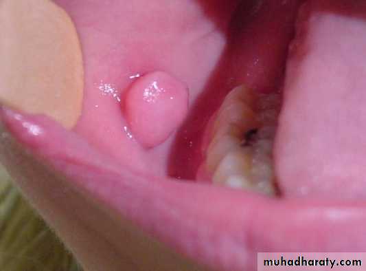 benign tumor and tumor like lesion