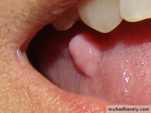 benign tumor and tumor like lesion