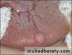 benign tumor and tumor like lesion