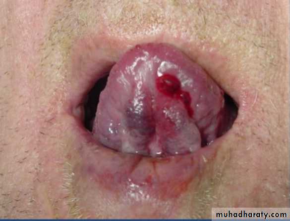 benign tumor and tumor like lesion