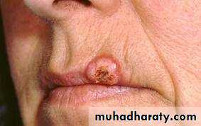 benign tumor and tumor like lesion