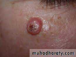 benign tumor and tumor like lesion