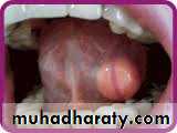 benign tumor and tumor like lesion
