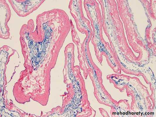 benign tumor and tumor like lesion