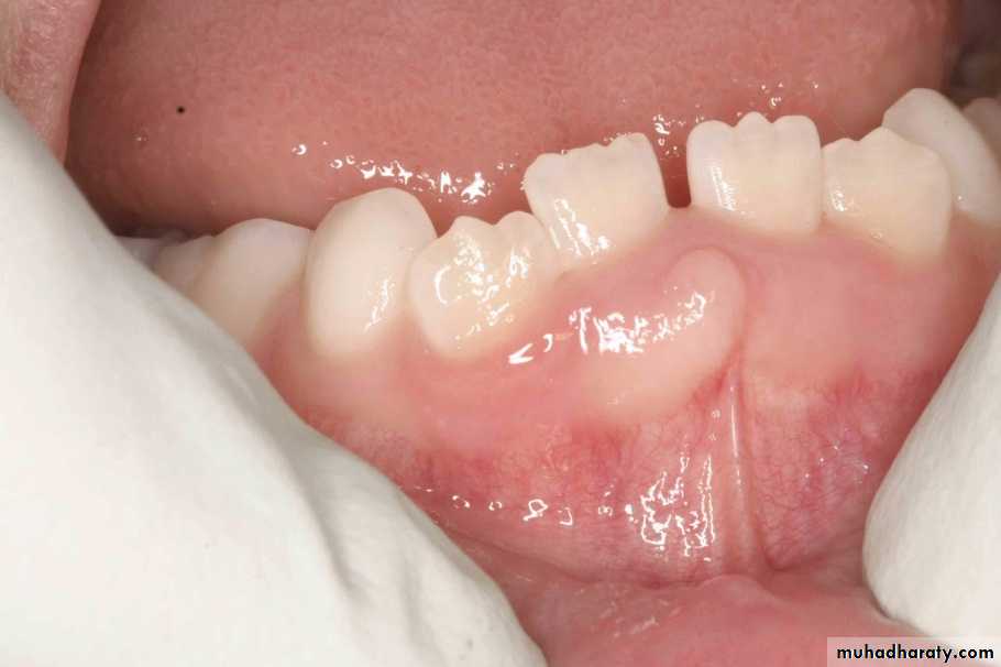 benign tumor and tumor like lesion