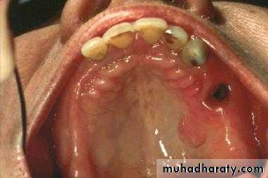 benign tumor and tumor like lesion