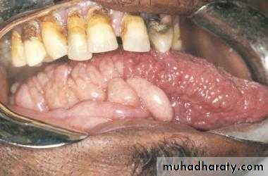 benign tumor and tumor like lesion