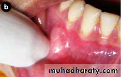 benign tumor and tumor like lesion