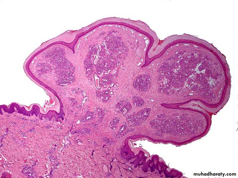 benign tumor and tumor like lesion
