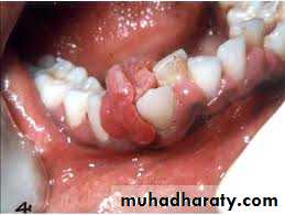 benign tumor and tumor like lesion