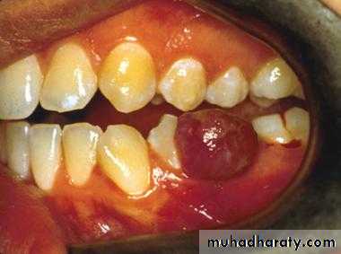 benign tumor and tumor like lesion
