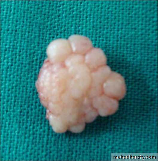 benign tumor and tumor like lesion